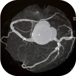 Calcium CT
